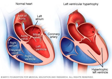 SEARCH AND BUY THIS PRODUCT Left ventricular hypertrophy Disease Reference Guide