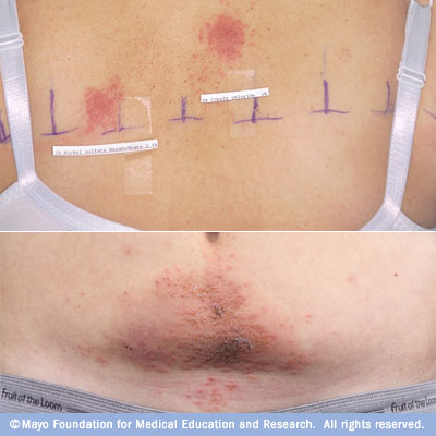 Skin Cancer May Increase Your Risk of OTHER Cancers Skin Cancer May Increase Your Risk of OTHER Cancers new picture Skin Cancer May Increase Your Risk of OTHER Cancers Skin Cancer May Increase Your Risk of OTHER Cancers new photo