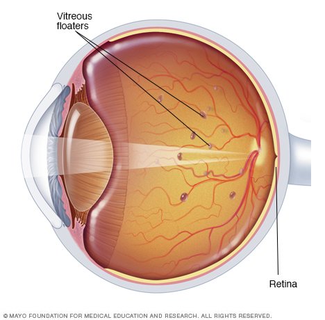 Eye floaters Disease Reference Guide - Drugs.com