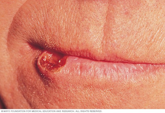 cancer mouth lip sore drugs heal