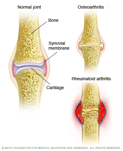 osteoarthritis synovitis