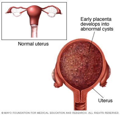 molar pregnancy an abnormal form of A molar pregnancy — also known as hydatidiform mole — is a rare complication of pregnancy characterized by the abnormal growth of trophoblasts, the cells that normally develop into the placenta there are two types of molar pregnancy, complete molar pregnancy and partial molar pregnancy in a . molar pregnancy an abnormal form of A molar pregnancy — also known as hydatidiform mole — is a rare complication of pregnancy characterized by the abnormal growth of trophoblasts, the cells that normally develop into the placenta there are two types of molar pregnancy, complete molar pregnancy and partial molar pregnancy in a .