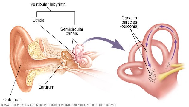 vestibular tubes benign paroxysmal positional vertigo bppv disease vestibular tubes benign paroxysmal positional vertigo bppv disease