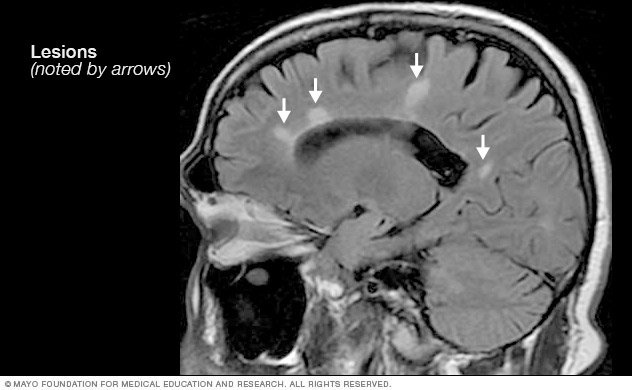 Multiple sclerosis Disease Reference Guide - Drugs.com