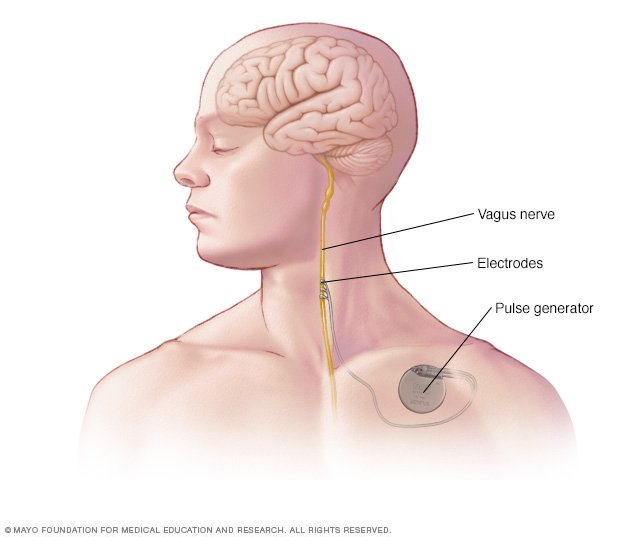 Vagus nerve stimulation - Drugs.com