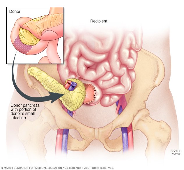 Pancreas transplant