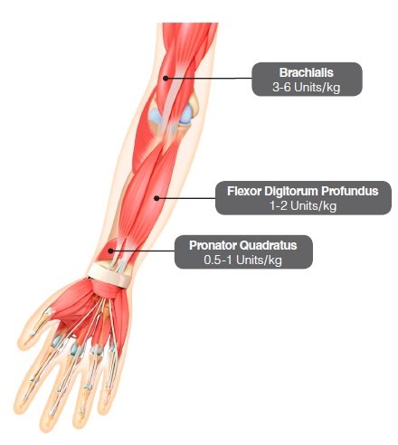 figure4-2_pediatric_spasticity