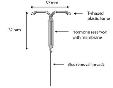 Figure 1 LILETTA Intrauterine Contraceptive System (IUS)