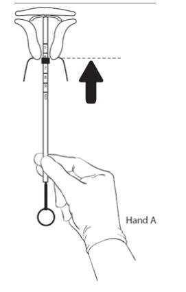 Figure 10: After 10 – 15 seconds, advance to the fundus while holding both the rod and the tube.