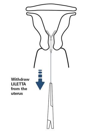 Figure 13: Removal of LILETTA