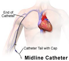 Picture of person with midline catheter