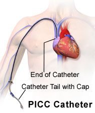 Picture of person with PICC catheter in right arm