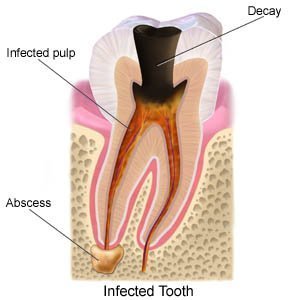 Root Canal Treatment (Aftercare Instructions) - What You ...