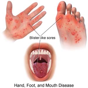 Image result for hand foot and mouth disease