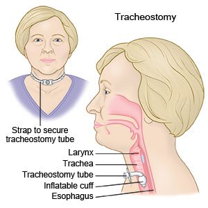 tracheostomy care