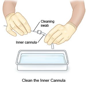 Clean the Inner Cannula