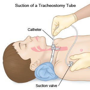 How do you care for a tracheostomy at home?