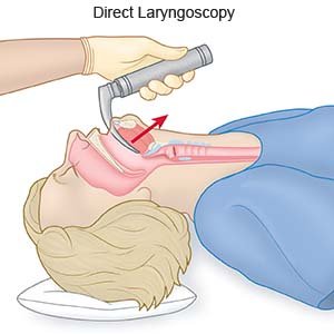 Direct Laryngoscopy