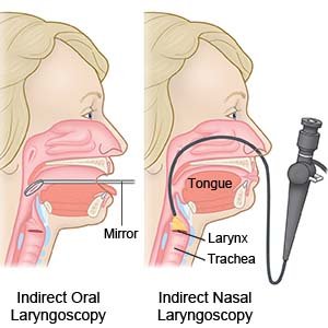 Indirect Oral Laryngoscopy Indirect Nasal Laryngoscopy