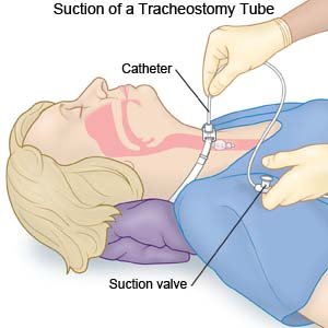 Suction of a Tracheostomy Tube