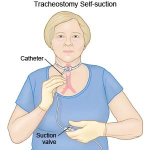 Tracheostomy Self Suction