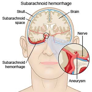 Subarachnoid Hemorrhage (SAH) - Physiopedia