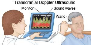 Transcranial Doppler Ultrasound