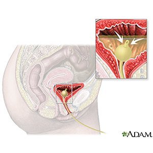 foley catheter placement and care what you need to know foley bulb