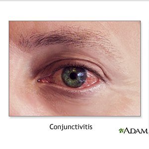 types of conjunctivitis discharge