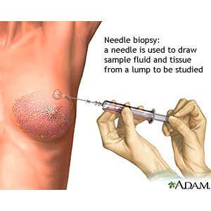 Best of What is a core biopsy of the breast Quality porn Kleio valentien cosplay