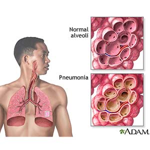 Can Mucus Cough Irritate Throat After Food Can Mucus Cough Irritate Throat After Food