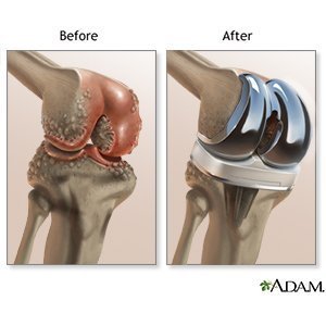Image result for total knee replacement