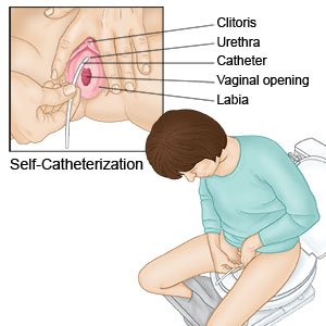 Self-Ctheterization