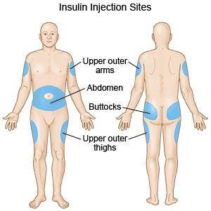 How to Give an Insulin Injection - What You Need to Know