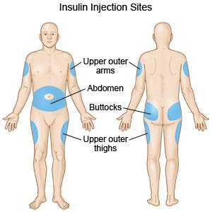 Side Effects Of Toujeo Insulin Glargine Injection For Subcutaneous Use Warnings Uses Insulin Cold Symptoms Side Effects