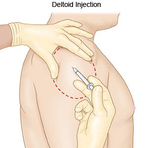 injekce deltového svalu