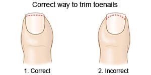 Correct way to trim toenails