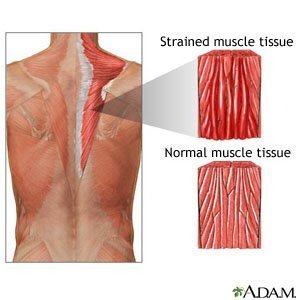 Steroid effects on bone tissue