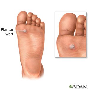 wart foot soak