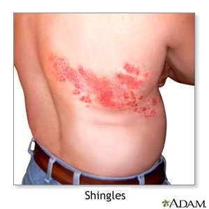 Can shingles cause neuropathy?