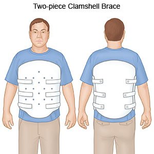 Clamshell Brace - What You Need to Know