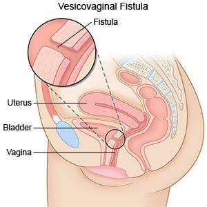 Vesicovaginal Fistula