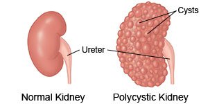 Normal Kidney Polycystic Kidney
