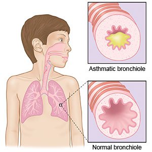Normal vs Asthmatic Bronchioles