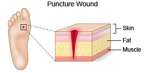 Puncture Wound