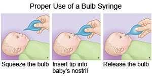 Proper Use of Bulb Syringe