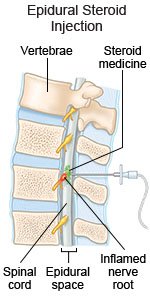 Epidural Steroid Injection