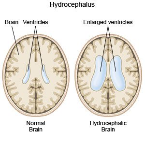 Hydrocephalus 