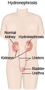 Hydronephrosis 