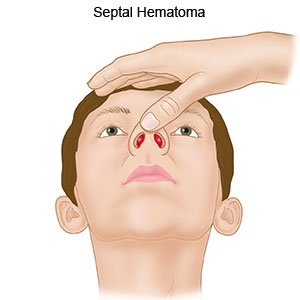 Septal Hematoma 